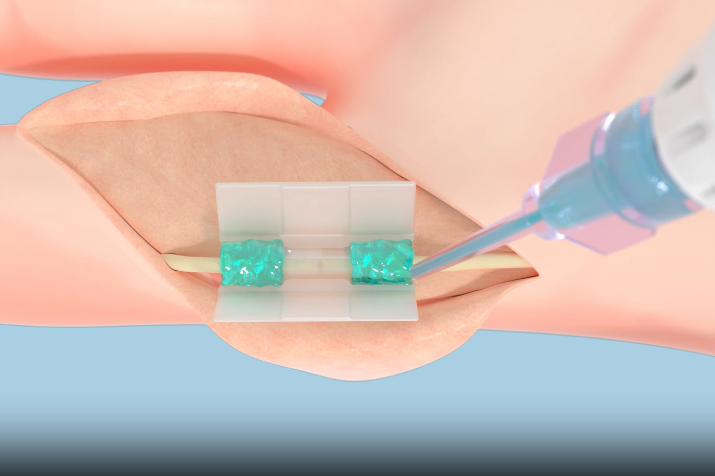 Ushering in a new era of suture-free tissue reconstruction for better healing | MIT News