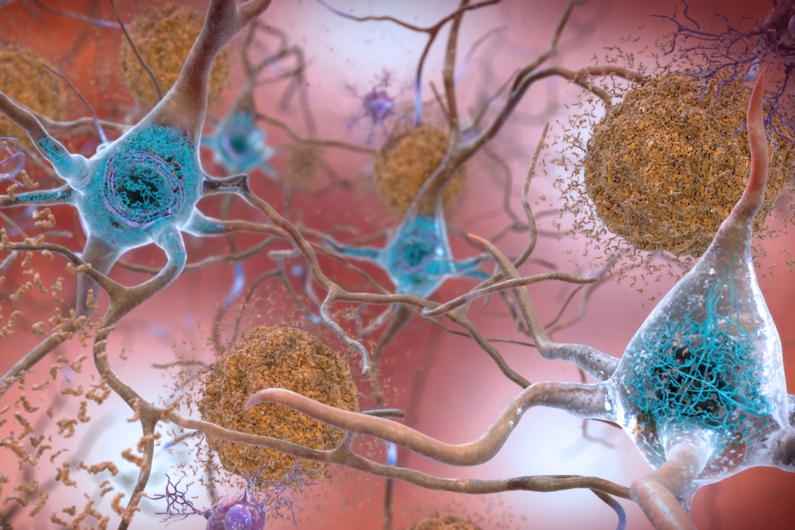Study explains how a rare gene variant contributes to Alzheimer’s disease | MIT News