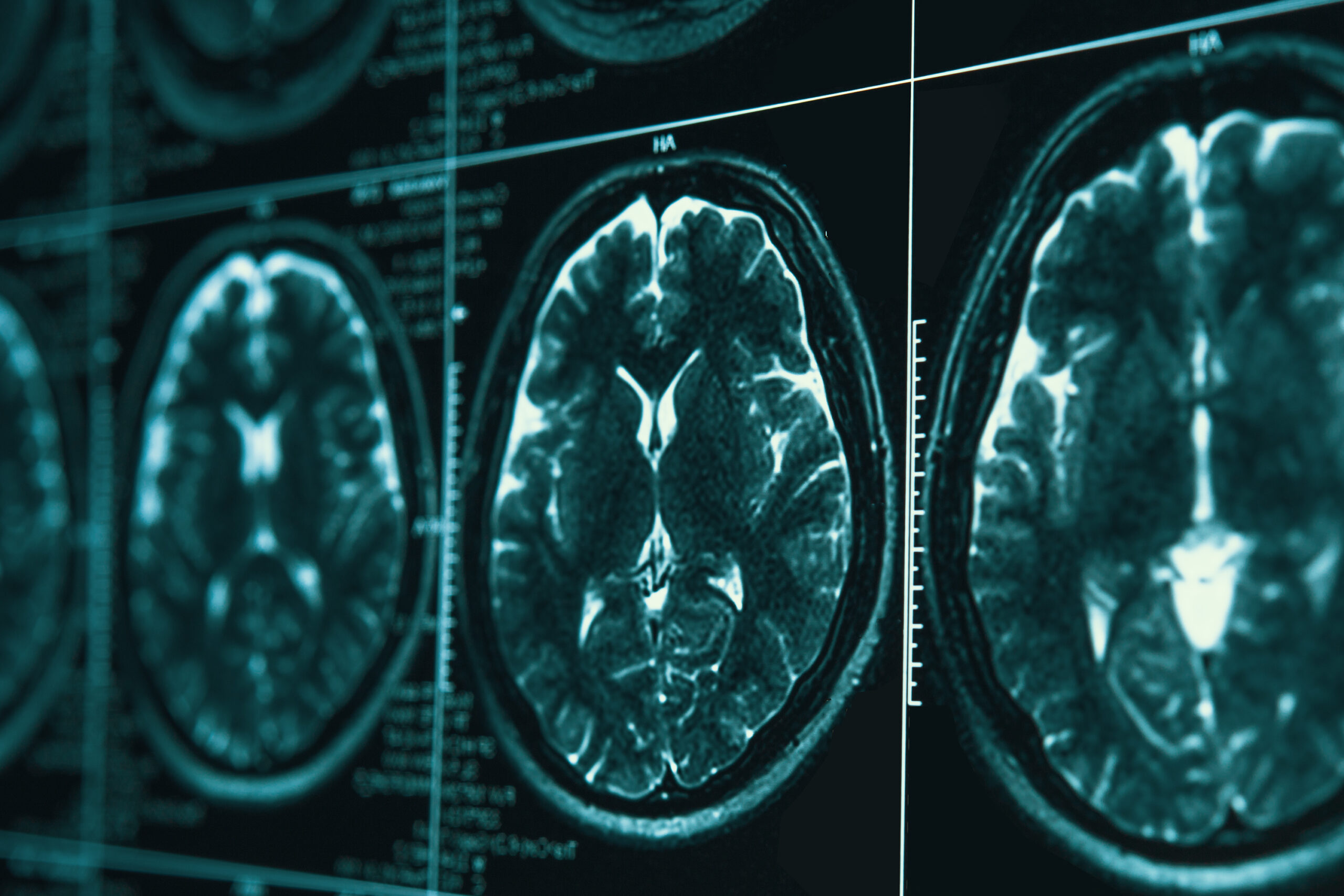 Making real gains in war on Alzheimer’s — Harvard Gazette