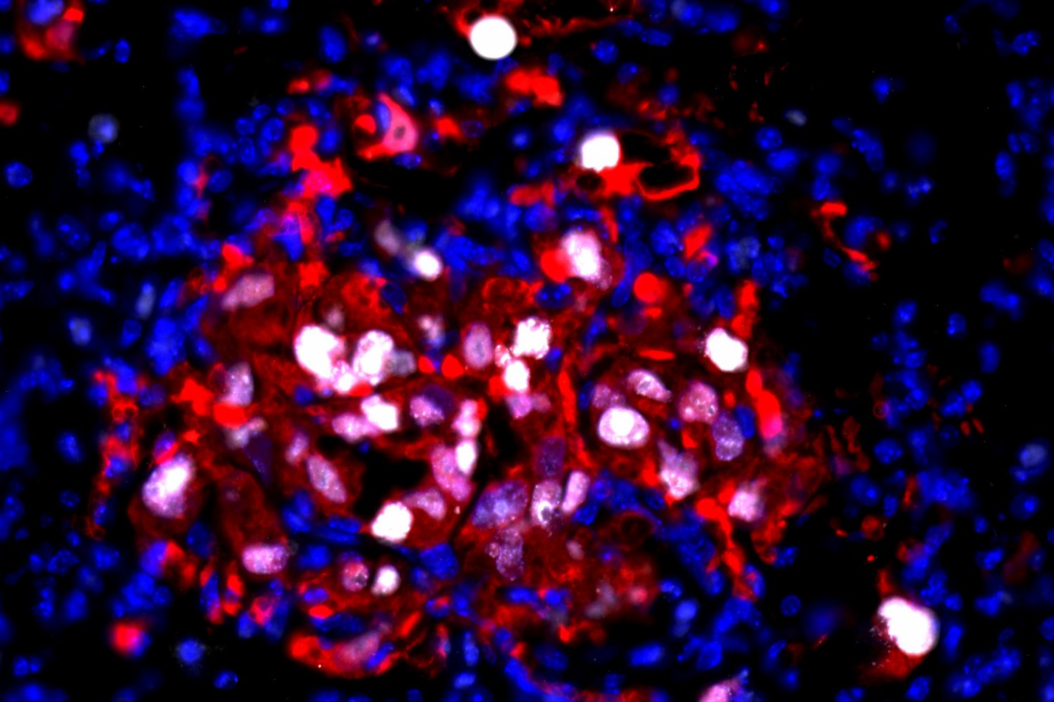 Inflammation jolts “sleeping” cancer cells awake, enabling them to multiply again | MIT News